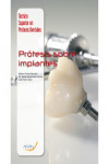 Prótesis sobre implantes | 9788416141807 | Portada